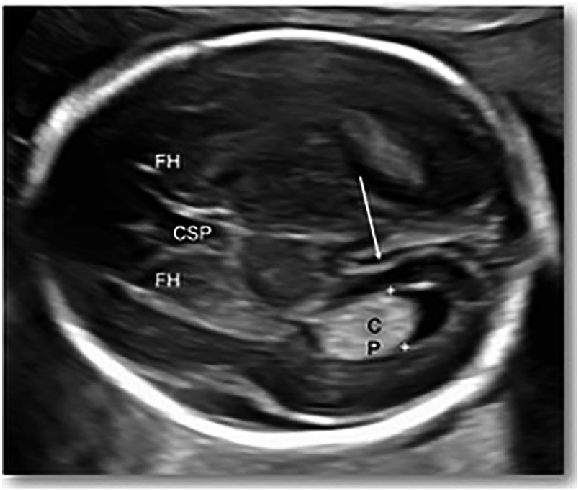 2 Boyutlu Fetal Beyin Ultrasonografisinde Lateral Ventrikül Anomalilerinin Yapay Zekâ Destekli Tespiti 